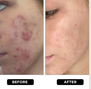 Acnoza anti acne serum